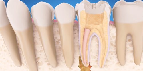 Endodontic Retreatment 2